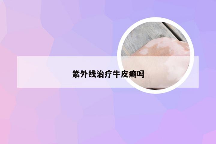 紫外线治疗牛皮癣吗