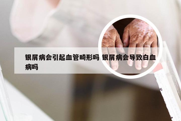 银屑病会引起血管畸形吗 银屑病会导致白血病吗