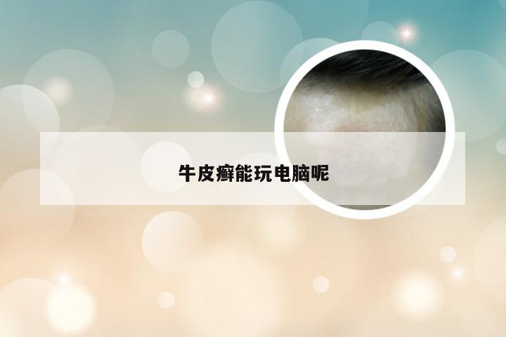 牛皮癣能玩电脑呢