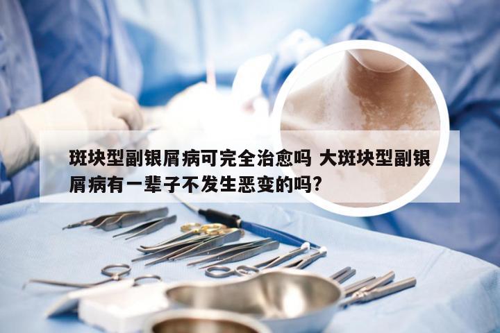 斑块型副银屑病可完全治愈吗 大斑块型副银屑病有一辈子不发生恶变的吗?