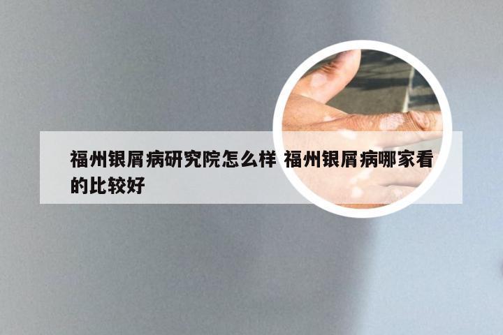 福州银屑病研究院怎么样 福州银屑病哪家看的比较好