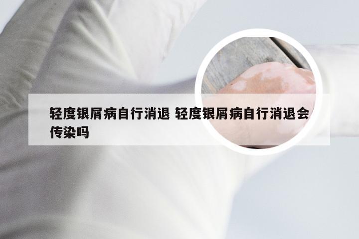 轻度银屑病自行消退 轻度银屑病自行消退会传染吗