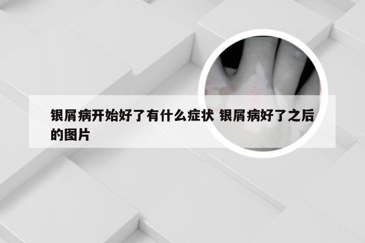 银屑病开始好了有什么症状 银屑病好了之后的图片