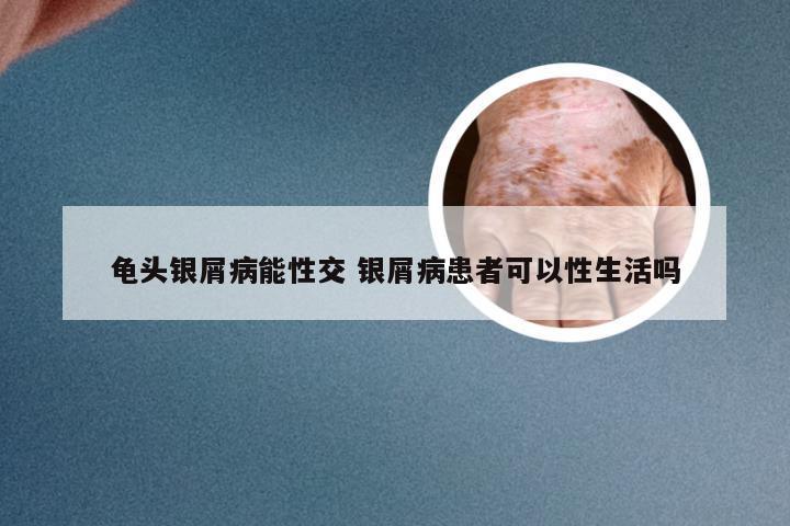 龟头银屑病能性交 银屑病患者可以性生活吗