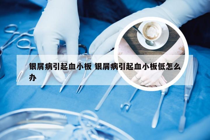 银屑病引起血小板 银屑病引起血小板低怎么办