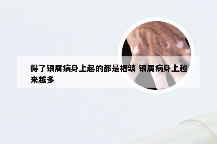 得了银屑病身上起的都是褶皱 银屑病身上越来越多