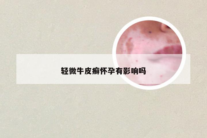 轻微牛皮癣怀孕有影响吗