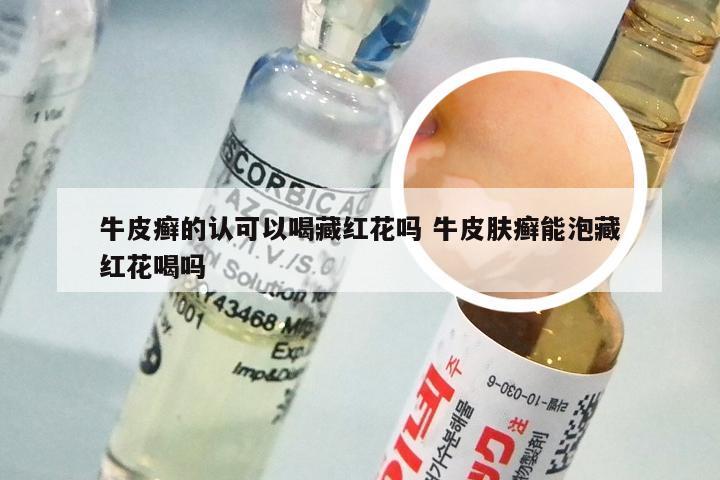 牛皮癣的认可以喝藏红花吗 牛皮肤癣能泡藏红花喝吗