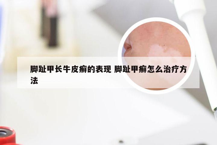 脚趾甲长牛皮癣的表现 脚趾甲癣怎么治疗方法