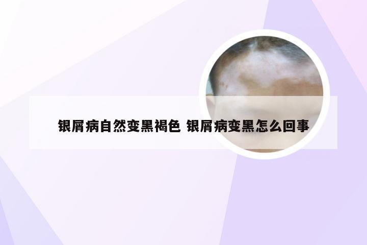 银屑病自然变黑褐色 银屑病变黑怎么回事