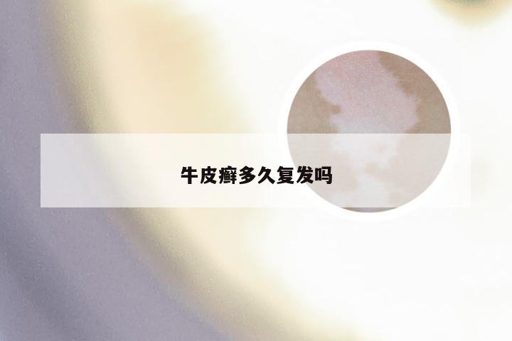 牛皮癣多久复发吗
