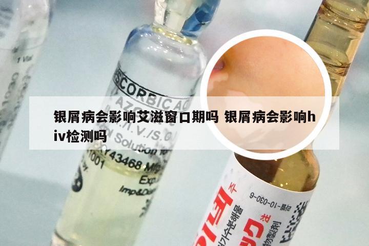 银屑病会影响艾滋窗口期吗 银屑病会影响hiv检测吗