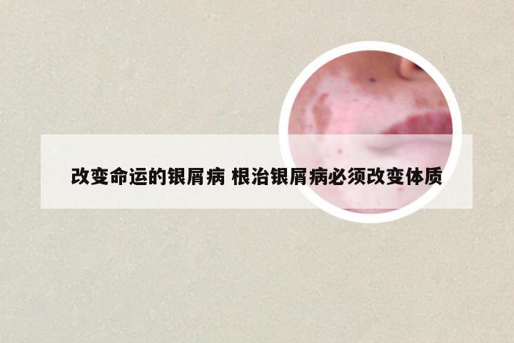 改变命运的银屑病 根治银屑病必须改变体质