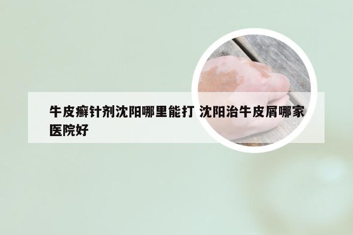 牛皮癣针剂沈阳哪里能打 沈阳治牛皮屑哪家医院好