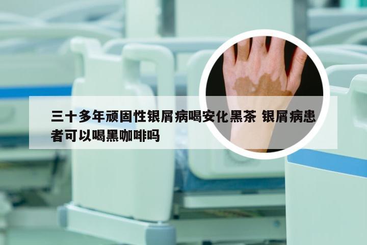 三十多年顽固性银屑病喝安化黑茶 银屑病患者可以喝黑咖啡吗