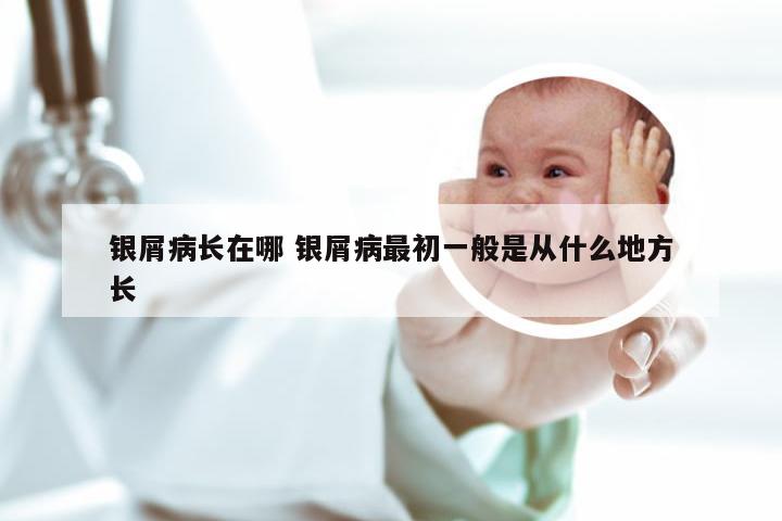 银屑病长在哪 银屑病最初一般是从什么地方长