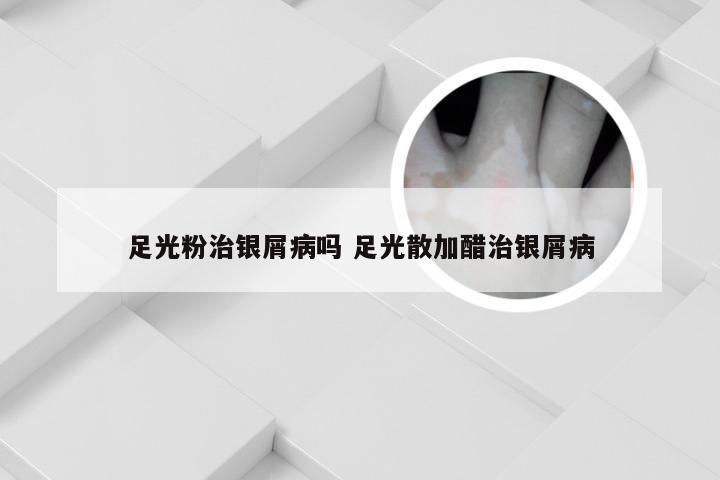 足光粉治银屑病吗 足光散加醋治银屑病