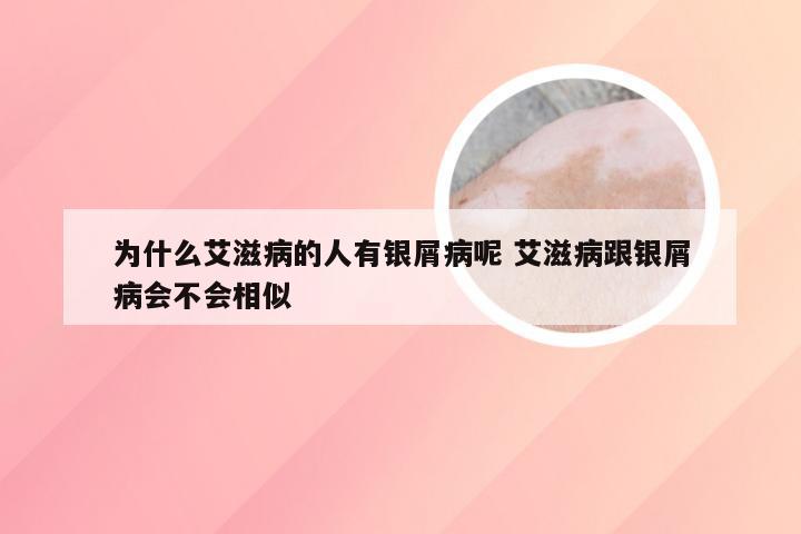 为什么艾滋病的人有银屑病呢 艾滋病跟银屑病会不会相似
