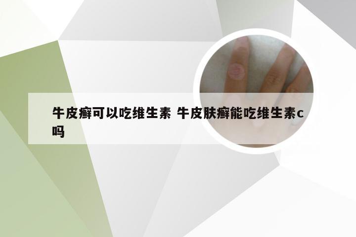牛皮癣可以吃维生素 牛皮肤癣能吃维生素c吗