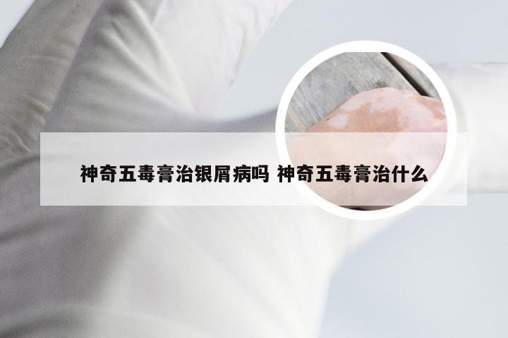神奇五毒膏治银屑病吗 神奇五毒膏治什么