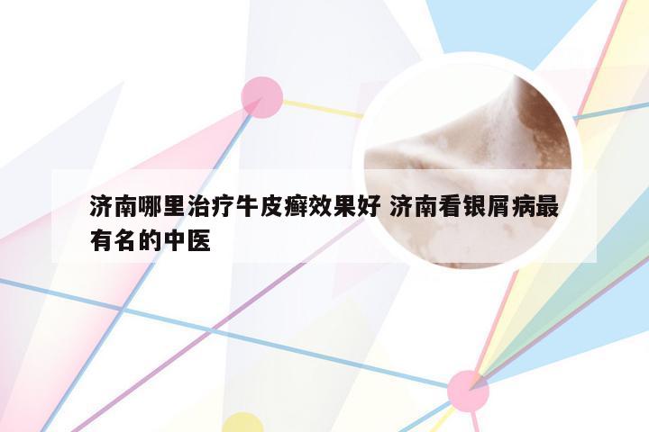 济南哪里治疗牛皮癣效果好 济南看银屑病最有名的中医