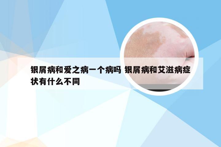 银屑病和爱之病一个病吗 银屑病和艾滋病症状有什么不同