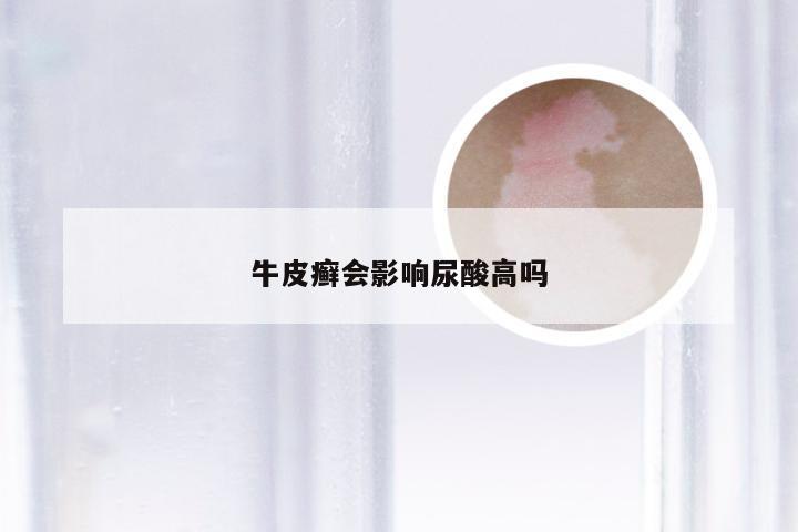 牛皮癣会影响尿酸高吗