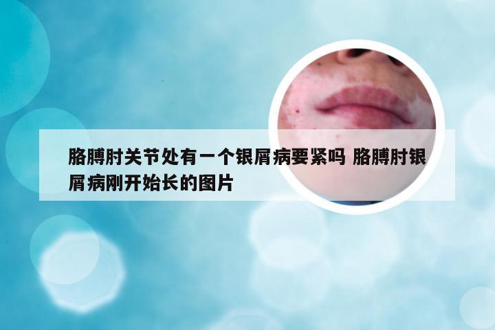 胳膊肘关节处有一个银屑病要紧吗 胳膊肘银屑病刚开始长的图片
