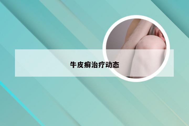 牛皮癣治疗动态