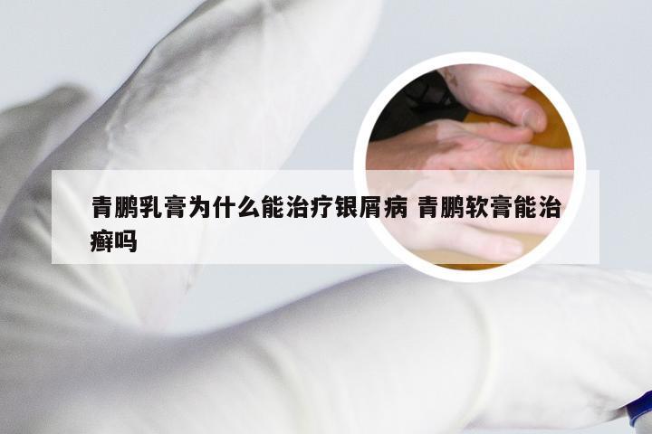 青鹏乳膏为什么能治疗银屑病 青鹏软膏能治癣吗