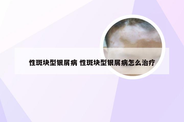 性斑块型银屑病 性斑块型银屑病怎么治疗