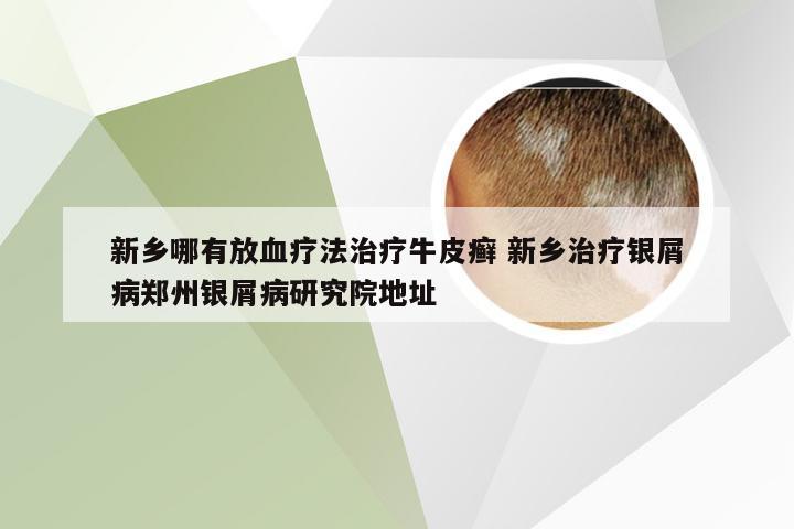 新乡哪有放血疗法治疗牛皮癣 新乡治疗银屑病郑州银屑病研究院地址