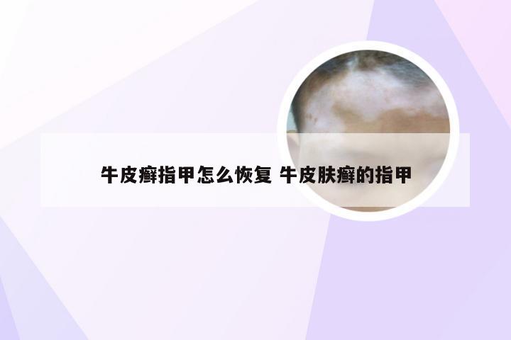牛皮癣指甲怎么恢复 牛皮肤癣的指甲