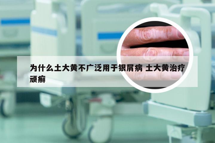 为什么土大黄不广泛用于银屑病 土大黄治疗顽癣