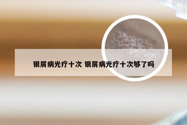 银屑病光疗十次 银屑病光疗十次够了吗