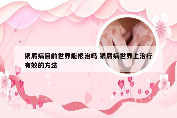 银屑病目前世界能根治吗 银屑病世界上治疗有效的方法