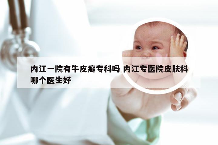 内江一院有牛皮癣专科吗 内江专医院皮肤科哪个医生好
