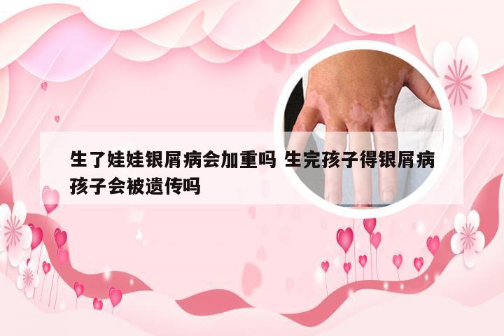 生了娃娃银屑病会加重吗 生完孩子得银屑病孩子会被遗传吗