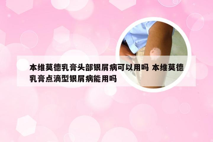 本维莫德乳膏头部银屑病可以用吗 本维莫德乳膏点滴型银屑病能用吗