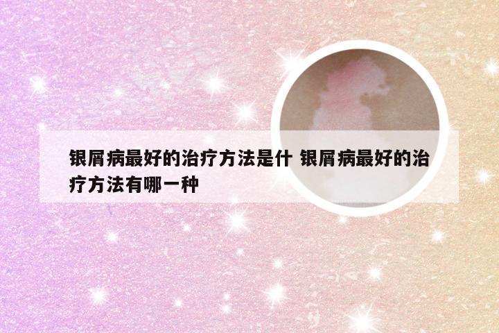 银屑病最好的治疗方法是什 银屑病最好的治疗方法有哪一种