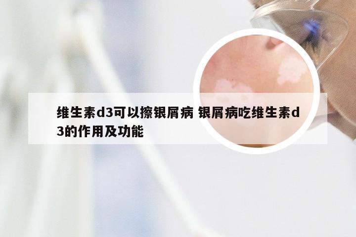 维生素d3可以擦银屑病 银屑病吃维生素d3的作用及功能