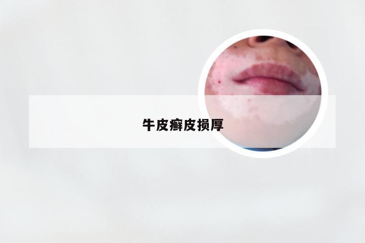 牛皮癣皮损厚