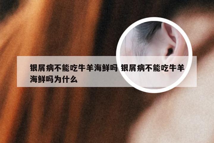 银屑病不能吃牛羊海鲜吗 银屑病不能吃牛羊海鲜吗为什么