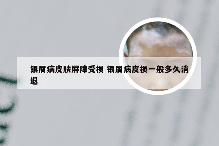 银屑病皮肤屏障受损 银屑病皮损一般多久消退