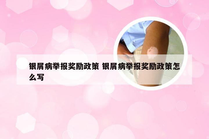 银屑病举报奖励政策 银屑病举报奖励政策怎么写