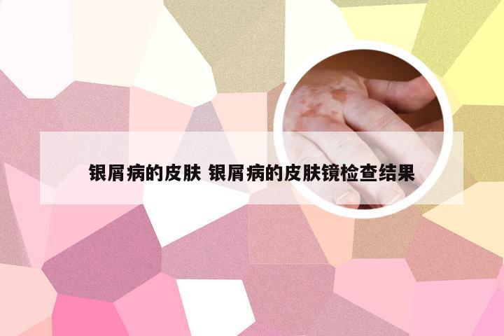 银屑病的皮肤 银屑病的皮肤镜检查结果