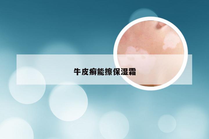 牛皮癣能擦保湿霜