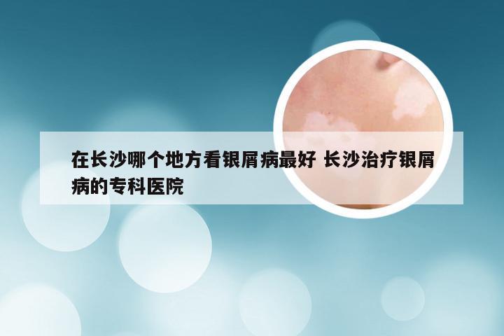 在长沙哪个地方看银屑病最好 长沙治疗银屑病的专科医院