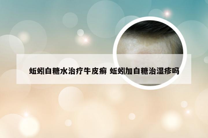 蚯蚓白糖水治疗牛皮癣 蚯蚓加白糖治湿疹吗