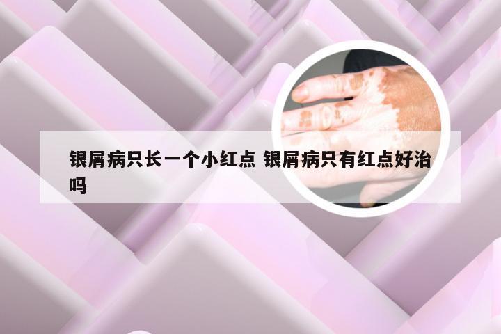 银屑病只长一个小红点 银屑病只有红点好治吗